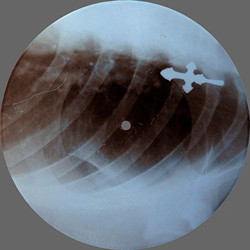 One-sided flexible record made of X-ray pattern – односторонняя гибкая пластинка, сделанная из рентгеновского снимка